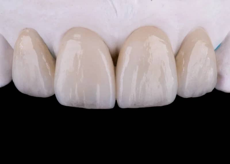E.max (Lithium Disilicate)
