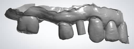 Avoid The Most Common Implant Scanning Mistakes
